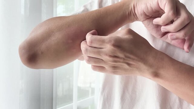 Young asian man itching and scratching on arm from itchy dry skin eczema dermatitis