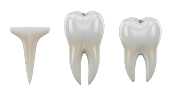 Isolated molar teeth exhibiting healthy, restored, and decayed states in a 3D rendering