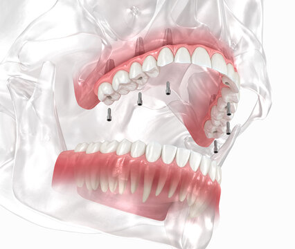 Maxillary prosthesis with gum All on 6 system supported by implants. Dental 3D illustration