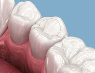 Toth restoration with filling. 3D illustration.