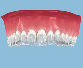 Invisalign braces or invisible retainer. Dental 3D illustration