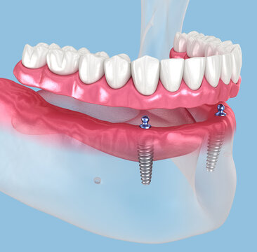 Mandibular removable prosthesis All on 2 system supported by implants with ball attachments. 3D illustration