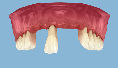Periodontitis and gum recession. Medically accurate 3D illustration