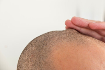 Fototapeta premium Head trauma after accident, man with swollen bump, injury concept, Man suffering from head injury, swollen bump on forehead, pain and trauma, emergency attention, pain management, body hair