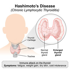 Fototapeta premium Hashimoto’s Disease (Chronic Lymphocytic Thyroiditis)