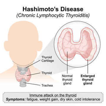 Hashimoto&rsquo;s Disease (Chronic Lymphocytic Thyroiditis)