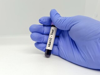 Obraz premium Scientist hold blood sample test tube for HbA1C Test or Hemoglobin A1C Test Diabetic treatment monitoring test.