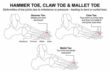 Hammer Toe, Claw Toe & Mallet Toe