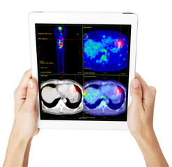Hand interacting with tablet displaying PET/CT scans. Multiview diagnostic imaging highlights abnormal metabolic activity. Ideal for medical, oncology, and tech-related visuals.