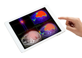 Hand interacting with tablet displaying PET/CT scans. Multiview diagnostic imaging highlights abnormal metabolic activity. Ideal for medical, oncology, and tech-related visuals.