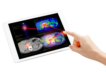 Hand interacting with tablet displaying PET/CT scans. Multiview diagnostic imaging highlights abnormal metabolic activity. Ideal for medical, oncology, and tech-related visuals.