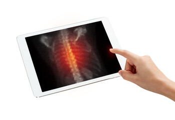 Hand interacting with tablet displaying PET/CT scans. Multiview diagnostic imaging highlights abnormal metabolic activity. Ideal for medical, oncology, and tech-related visuals.