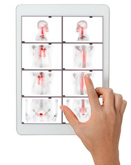 Hand interacting with tablet displaying PET/CT scans. Multiview diagnostic imaging highlights abnormal metabolic activity. Ideal for medical, oncology, and tech-related visuals.