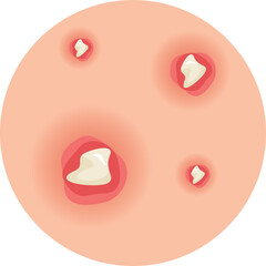 Acne and Pimple Vector Illustration