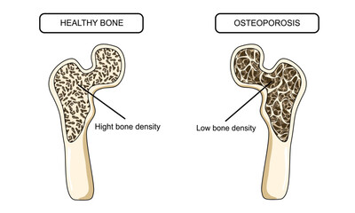 Illustration of osteoporosis and healthy bones. Systemic skeletal disorders, human hip bone, loss of bone mineral density. Risk of fracture. Vector illustration for medical, clinic, and education