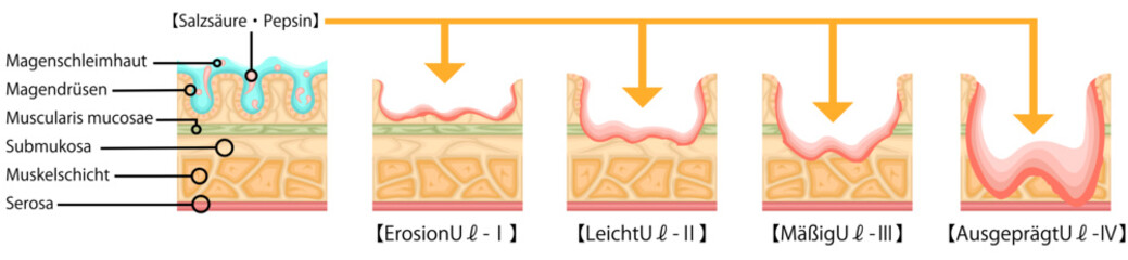 胃潰瘍　重症度　イラスト　ドイツ語
