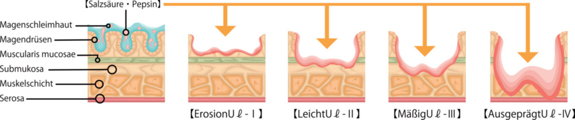 胃潰瘍　重症度　イラスト　ドイツ語