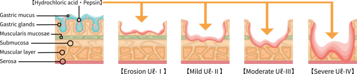 胃潰瘍　重症度　イラスト　英語