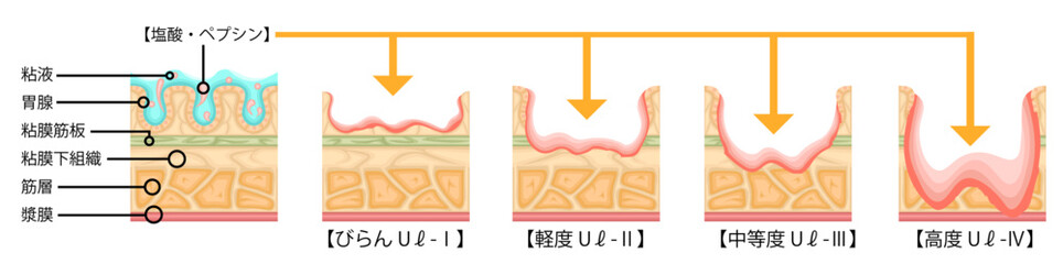 胃潰瘍　重症度　イラスト　日本語