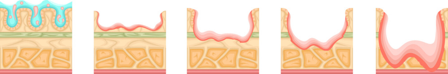 胃潰瘍　重症度　イラスト