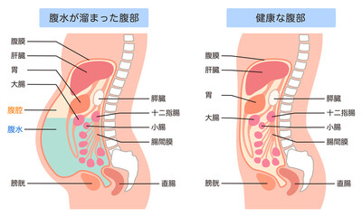腹水が溜まった腹部と、健康な腹部