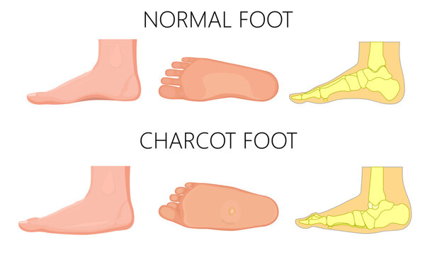 Normal and Charcot foot on a white bacground