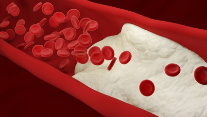 Atherosclerosis. Atheromatous plaques. Arteriosclerotic vascular disease. 3d illustration