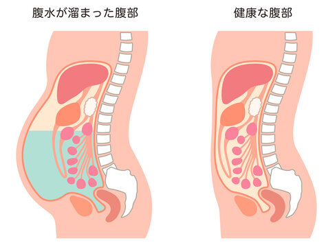腹水が溜まった腹部と、健康な腹部