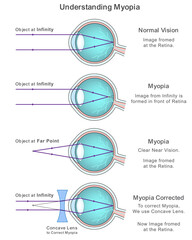 Myopia Explained with Infographic on Normal Vision and Corrective Concave Lens Solutions