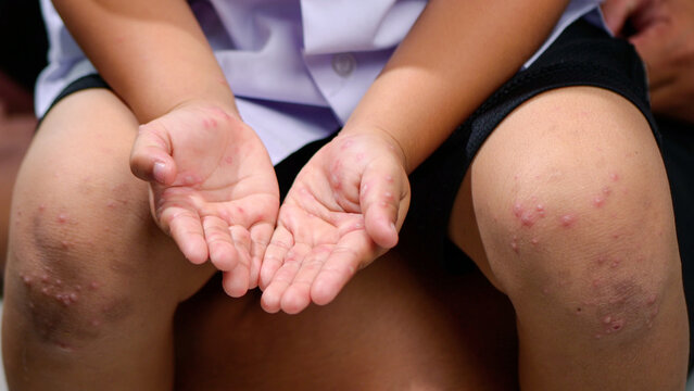 Hand, foot and mouth disease HFMD Human hand of scarlet fever in coxsackievirus palmarosa virus and child hand on white background