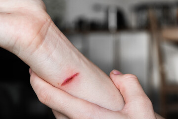 A close-up of a pale arm with a fresh burn mark. The skin shows a red line indicating injury. The...
