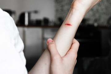 A close-up of a pale arm with a fresh burn mark. The skin shows a red line indicating injury. The...