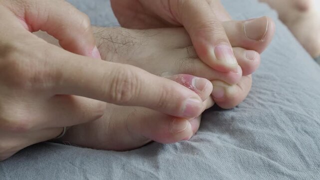 Swollen Purple bruise on the toe of male person foot. Injury of foot finger after home accident. Close-up of soft tissue edema and bruising on skin