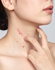 Close-up of a person's neck with skin lesions and finger