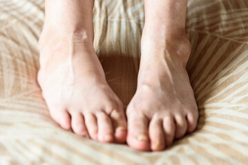 Woman's inflamed, swollen foot from a bruise on a bed at home.