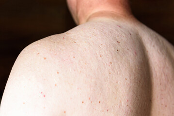 Fototapeta premium Red pimples on a man's back. Skin irritation and allergy concept. Diseases of the gastrointestinal tract.
