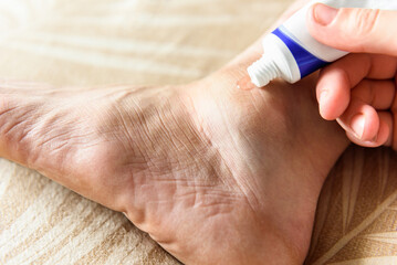 Woman's inflamed, swollen foot from a bruise on a bed at home.