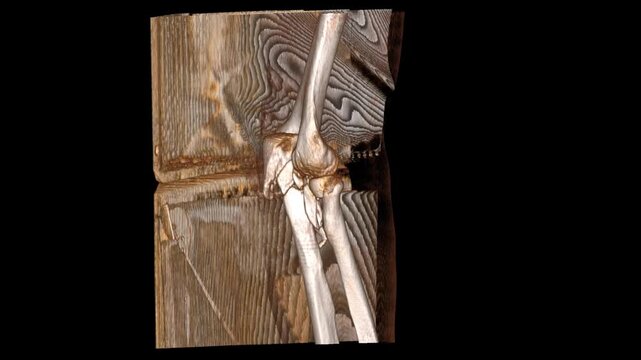 VR scan of the elbow highlighting detailed bone anatomy and joint alignment in thin-slice imaging. Ideal for orthopedic evaluation, fracture detection, and medical education.