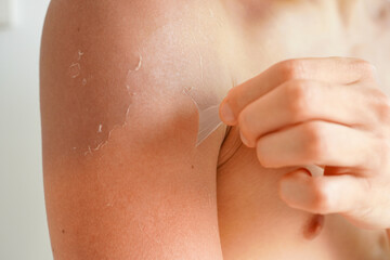 日焼けして皮がむけた若い男性