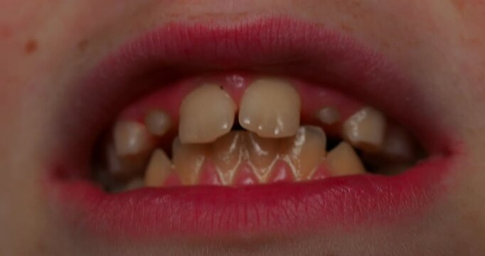 A child's baby and permanent teeth, close-up of the mouth