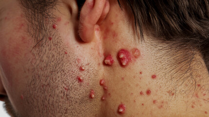 Close up of a man's face and neck with numerous red bumps and pustules, skin condition rash