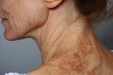 Close-up profile of an older adult's neck and shoulder showing hyperpigmentation, deep wrinkles, and sun damage, highlighting skin aging and dermatology concerns.
