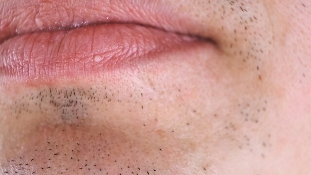 A white pimple on a lip. Extreme macro shot of an man's mouth. Stubble skin. Subcutaneous wen on the lips. First manifestation of herpes. Skin growth. A papilloma on the face. High quality photo