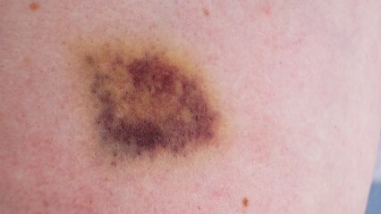 The bruise on skin close-up view. Various shades of healing process. Dark purple and yellow bruising colors on white skin. The violence concept. The consequences of injury. High quality 4k footage