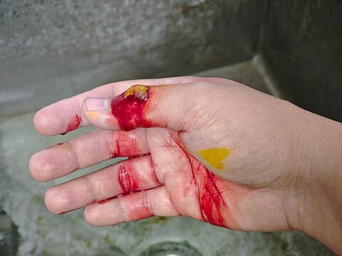hand with blood. A minor cut on hand cause bleeding non stop. 