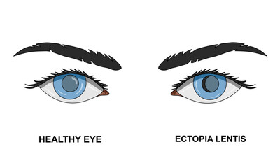 Illustration of Ectopia lentis, torn zonular fibers. Vision disorders, dislocated lens. Vector illustration of eye health, poster for medical, clinical and educational purposes.