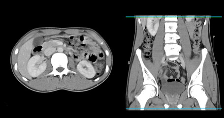 High-resolution CT scan Lower abdomen showing a normal lower abdomen for diagnostic reference,and healthcare presentations.Clear anatomical highlight healthy abdominal structure.
