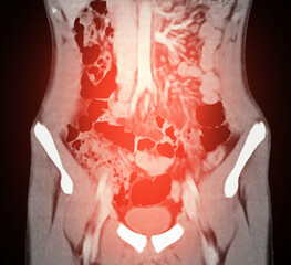 High-resolution CT scan Lower abdomen showing a normal lower abdomen for diagnostic reference,and healthcare presentations.Clear anatomical highlight healthy abdominal structure.