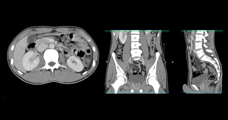  High-resolution CT scan Lower abdomen showing a normal lower abdomen for diagnostic reference,and healthcare presentations.Clear anatomical highlight healthy abdominal structure.