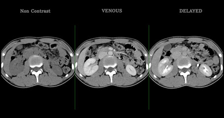  High-resolution CT scan Lower abdomen showing a normal lower abdomen for diagnostic reference,and healthcare presentations.Clear anatomical highlight healthy abdominal structure.